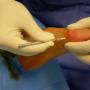 Alluce valgo con tecnica PERCUTANEA MININVASIVA