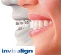INVISALIGN - RADDRIZZARE DENTI