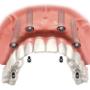 Implantologia dentale