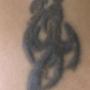 rimozione tatuaggi