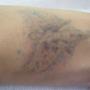 rimozione tatuaggi