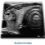 nodulo tiroideo
