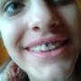 Smiley piercingg
