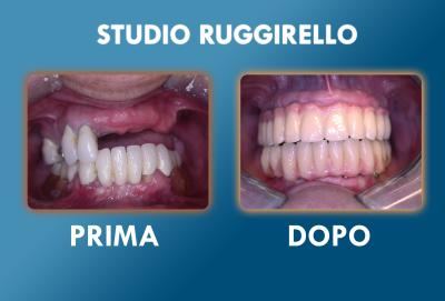 Implantologia