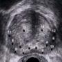 biopsia prostatica