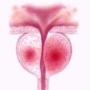 prostatite