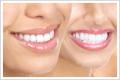 Sbiancamento Denti