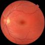 Laser per Oculistica
