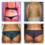 Liposuzione Salerno Dr Bove