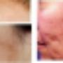Fusion Therapy