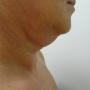 Liposuzione del Mento Pre intervento