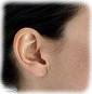 Otoplastica
