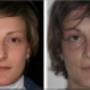 Foto Pre e Post operatorio - frontale