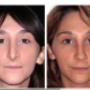 Foto Pre e Post operatorio - frontale