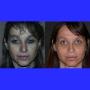 Foto Pre e Post operatorio - frontale