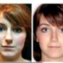 Foto Pre e Post operatorio - frontale