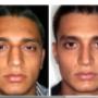 Foto Pre e Post operatorio - frontale
