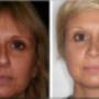 Foto Pre e Post operatorio - frontale