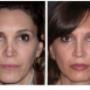 Foto Pre e Post operatorio - frontale
