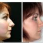 Foto Pre e Post operatorio - profilo