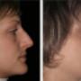 Foto Pre e Post operatorio - profilo