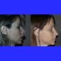 Foto Pre e Post operatorio - profilo