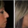 Foto Pre e Post operatorio - profilo