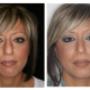 Foto Pre e Post operatorio