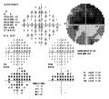 Perimetria Computerizzata