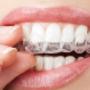 Apparecchi Dentali