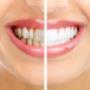 Studio Dentistico Gandolfo Sbiancamento Denti