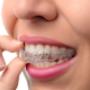 Apparecchio Dentale Trasparente