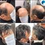 Impianto Capillare Uomo