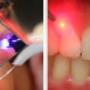 Laser Terapia per Piorrea