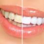 Sbiancamento Denti Centro Salute Orale Bologna