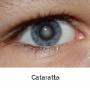 Cataratta