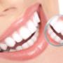 Sbiancatura Denti Studio Dentistico di Vito