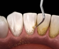 ablazione-tartaro-dentista-trabucco