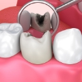 Odontoiatria Conservativa ed Endodonzia