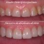 Faccette estetiche