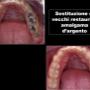 Rimozione Amalgama d'argento