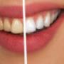 sbiancamento denti Roma