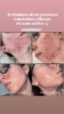Trattamento acne
