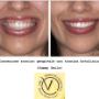 Correzione Sorriso Gengivale con Tossina Botulinica (Gummy Smile)