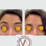 Trattamento rughe frontali con botox