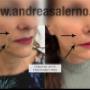 Filler Viso Aversa Caserta