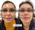 filler viso Aversa Caserta
