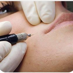 Cortinovis Depilazione