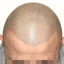 Dermatrico Repair [Tricopigmentazione]