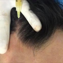 PRP Napoli - Tricologia